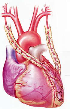 Coronary Artery Bypass Surgery