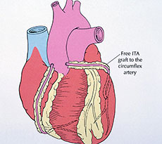 Coronary Artery Bypass Surgery Cardiology Specialists
