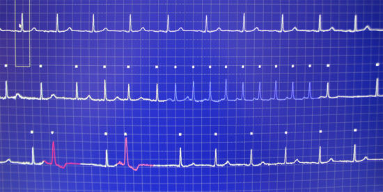 Understanding AFib: How to measure your own heart rate and rhythm