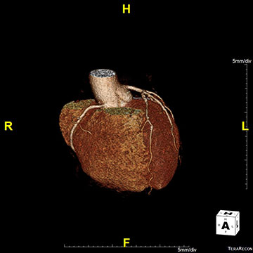 Coronary Angiography